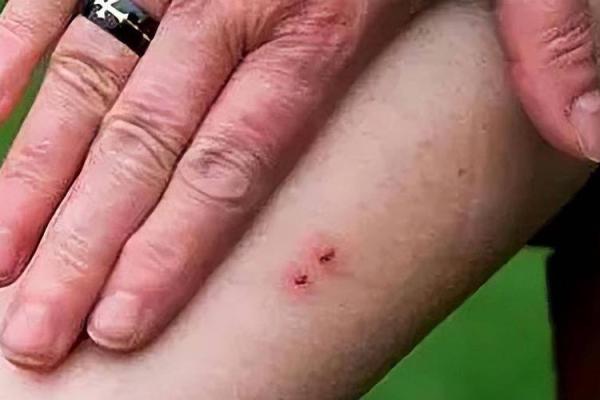 梦到被蛇咬是什么征兆 男性