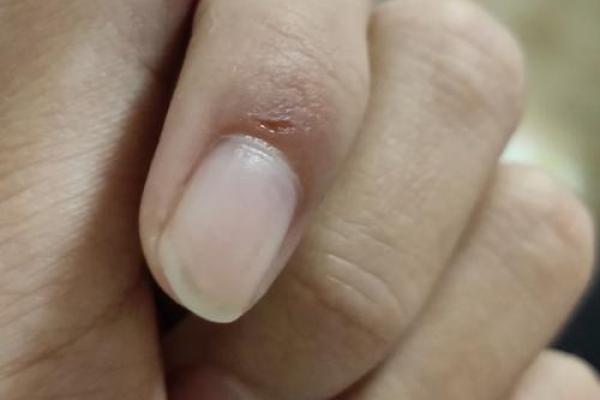 梦见狗抓伤自己的手